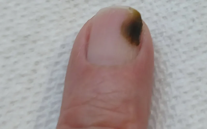 The darker, previously infected nail is being slowly replaced by healthy-appearing nail from the nail bed.