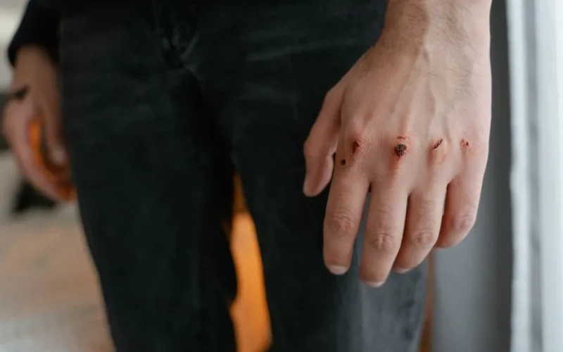 Detailed image of a hand with visible wounds and scratches, emphasizing injury.
